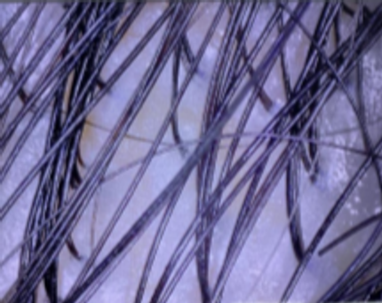 Scalp microscopy from RedLight Innovation’s study, participant 05, labelled day 90.