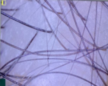 Scalp microscopy from RedLight Innovation’s study, participant 05, labelled day 0.